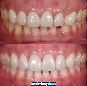 Be Dental - Nha Khoa Uy tín Quận Hai Bà Trưng Chuyên Bọc Răng Sứ, Tẩy Trắng Răng,Nhổ Răng Khôn, Trám Răng, Lấy Cao Răng Hai Bà Trưng Hà Nội