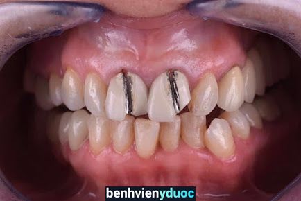 Be Dental - Nha Khoa Uy tín Quận Hai Bà Trưng Chuyên Bọc Răng Sứ, Tẩy Trắng Răng,Nhổ Răng Khôn, Trám Răng, Lấy Cao Răng Hai Bà Trưng Hà Nội