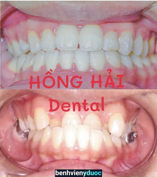 HỒNG HẢI Dental Sơn Tây Hà Nội