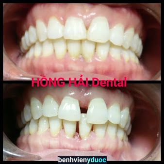 HỒNG HẢI Dental Sơn Tây Hà Nội