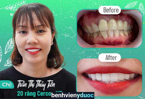 NHA KHOA ASIA UY TÍN QUẬN 9 TP HCM - NIỀNG RĂNG - BỌC RĂNG SỨ - TRỒNG RĂNG IMPLANT - TẨY TRẮNG RĂNG - NHỔ RĂNG KHÔN GIÁ RẺ Thủ Đức Hồ Chí Minh