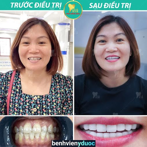 NHA KHOA ASIA UY TÍN QUẬN 9 TP HCM - NIỀNG RĂNG - BỌC RĂNG SỨ - TRỒNG RĂNG IMPLANT - TẨY TRẮNG RĂNG - NHỔ RĂNG KHÔN GIÁ RẺ Thủ Đức Hồ Chí Minh