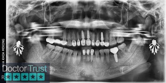 Trồng Răng Implant Mỹ Tho Tiền Giang Mỹ Tho Tiền Giang