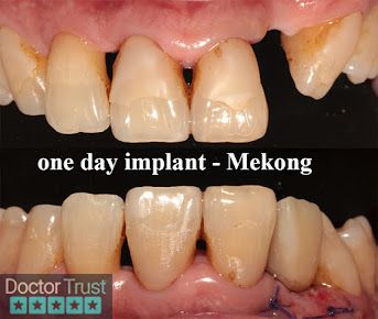 Trồng Răng Implant Mỹ Tho Tiền Giang Mỹ Tho Tiền Giang